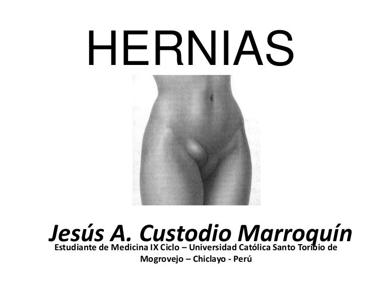 Riesgos de hernia umbilical en el embarazo